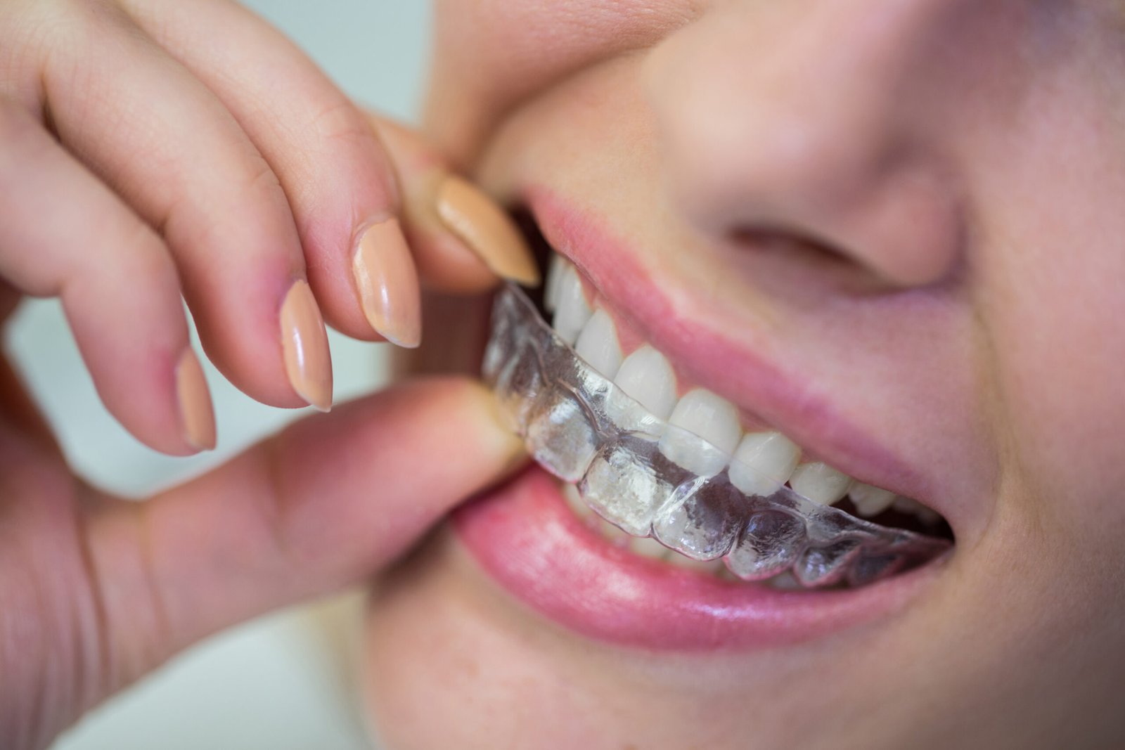 Why Invisalign Treatment Is the Modern Choice for Teeth Straightening