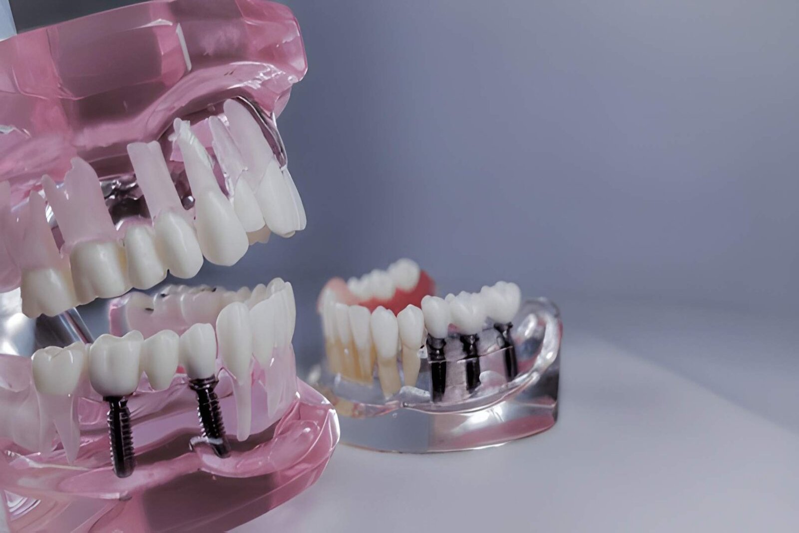 The 5 Types of Dental Implants Explained: Single Tooth, All-on-4, Mini & More