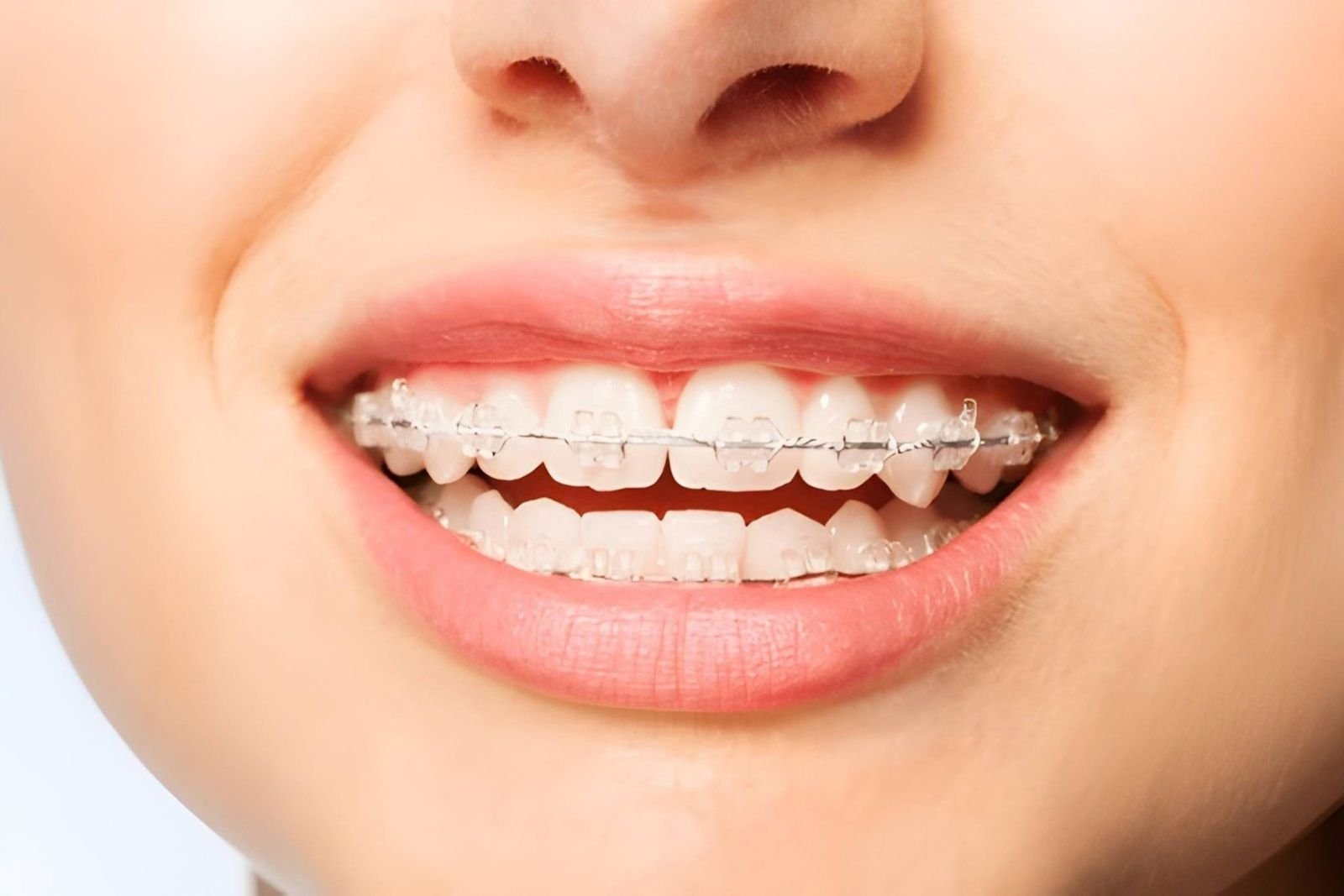 Are Clear Braces Painful? What to Expect During Treatment